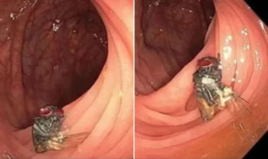 Xəstənin bağırsağında aşkar edilən canlı həkimləri təəccübləndirdi