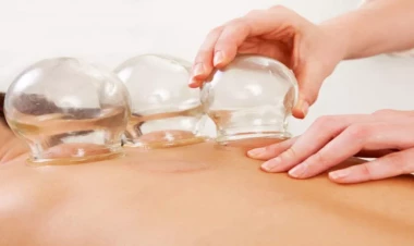 Hicamə - qan alma üsulu ilə müalicə