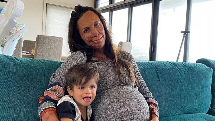 Bədəninin 65%-i yanmış modelin ilhamverici mübarizəsi - FOTOlar