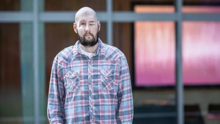 Dünyada ilk dəfə üz və göz transplantasiyası əməliyyatı keçirildi