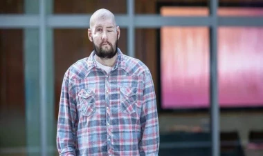 Dünyada ilk dəfə üz və göz transplantasiyası əməliyyatı keçirildi