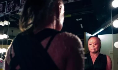 Fərqli görünüşünə görə anası atdı, insanlar ələ saldı - İndi bütün dünyaya ilham verir - FOTOlar