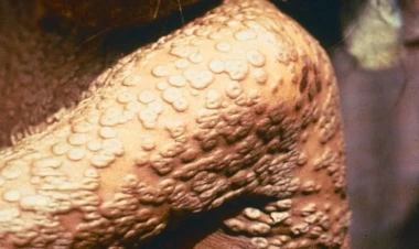 Dünyada çiçək xəstəliyi harada saxlanılır?