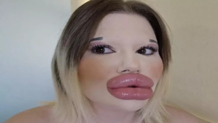 Dünyanın ən böyük dodaqlısı: Görün indi nə istəyir?