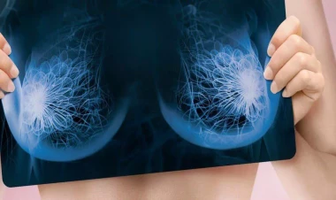 Süd vəzi xərçənginin əlamətləri - Onkoloq sadaladı