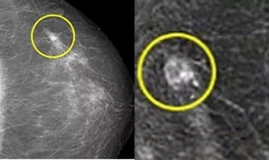 Onkoloq süd vəzisi xərçənginin əlamətlərini sadaladı: Ağrı, şişkinlik...