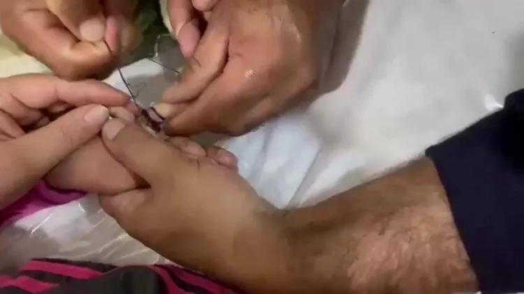 Bərdədə uşağın barmağına halqa ilişdi, köməyə FHN gəldi - VİDEO