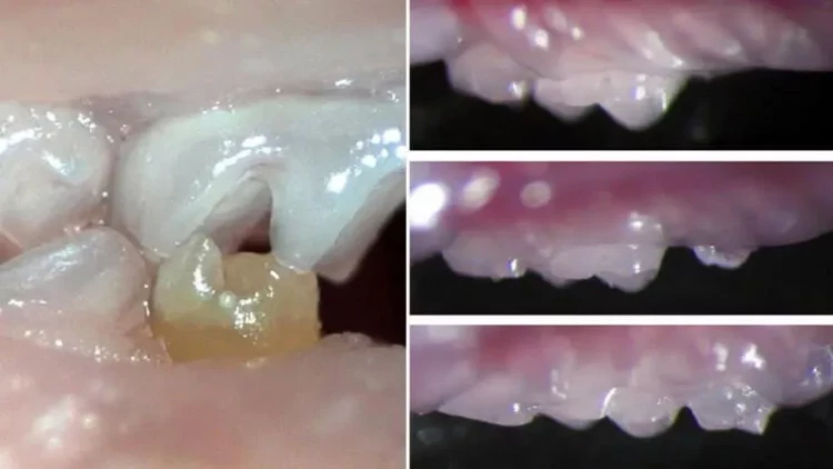 Protezə SON: Yeni dişlərin çıxmasına kömək edən dərman icad edildi