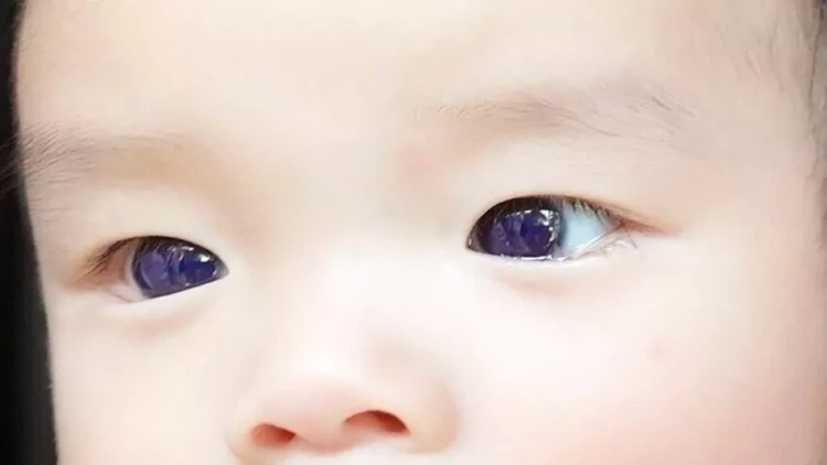 Dərman atan körpənin göz rəngi dəyişdi - Valideynləri dəhşət yaşadı