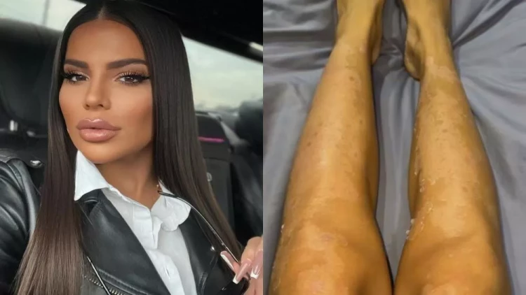 Bədəni çürüyən azərbaycanlı modeldən xəbər var - FOTO