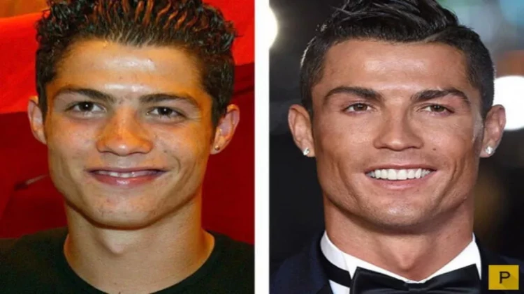 Məşhur kişilər plastik əməliyyatda əvvəl və sonra -FOTO