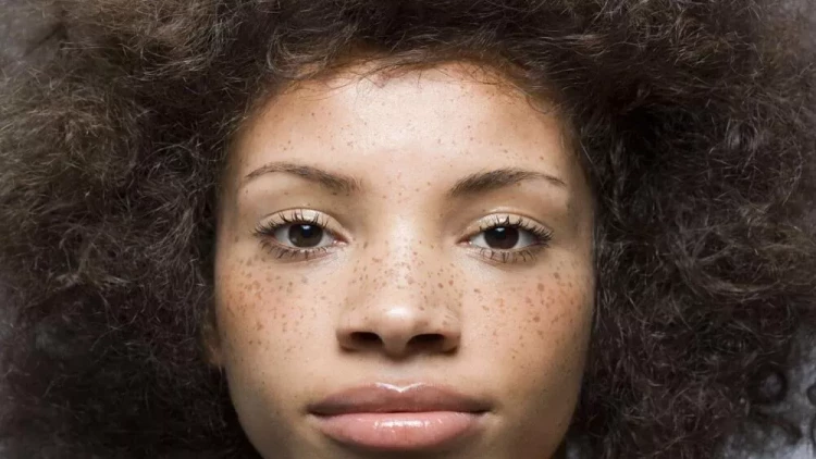 Günəşdən yaranan ləkələri BU YOLLA aradan qaldırın