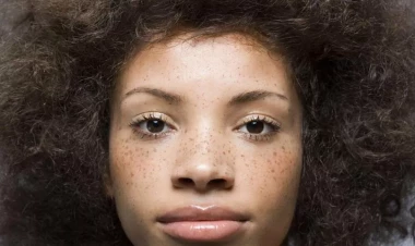 Günəşdən yaranan ləkələri BU YOLLA aradan qaldırın