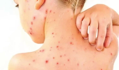 Qonşu ölkədə qorxulu xəstəliyin ocağı aşkar edildi