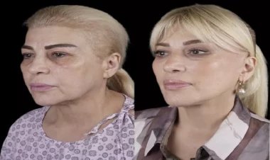 Əməkdar artist əməliyyatla tanınmaz hala düşdü - FOTO