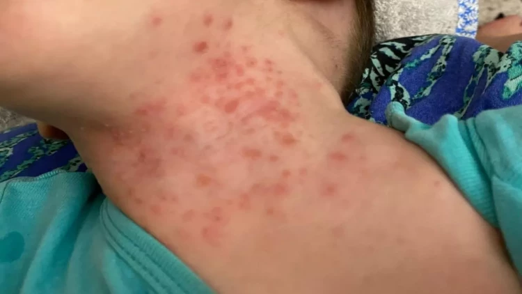 Uşaqlar arasında yeni virus yayılıb? - AÇIQLAMA