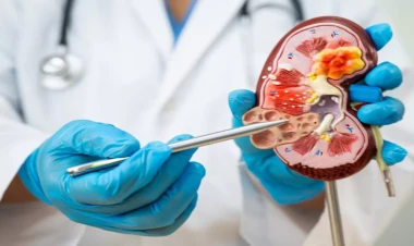 Böyrək daşlarının yaranmasına səbəb olan qidalar açıqlandı