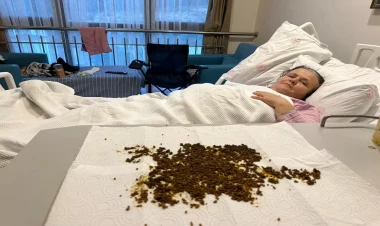 Qarın ağrısından şikayət etdi, ödündən 20 mindən çox daş çıxdı - FOTO