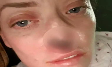 Türkiyədə implant etdirən qadının burnu çürüməyə başladı - VİDEO