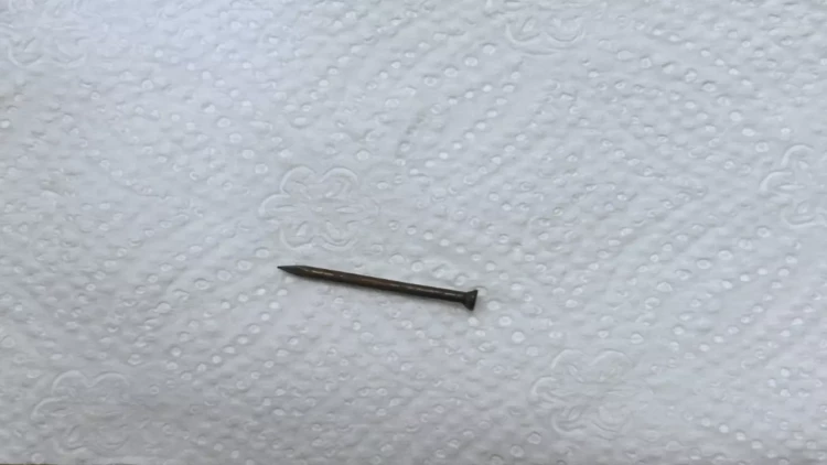 Bakıda azyaşlının mədəsindən mismar çıxarıldı - FOTO