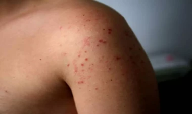 Bu virus dəmir dövründən bəri var imiş