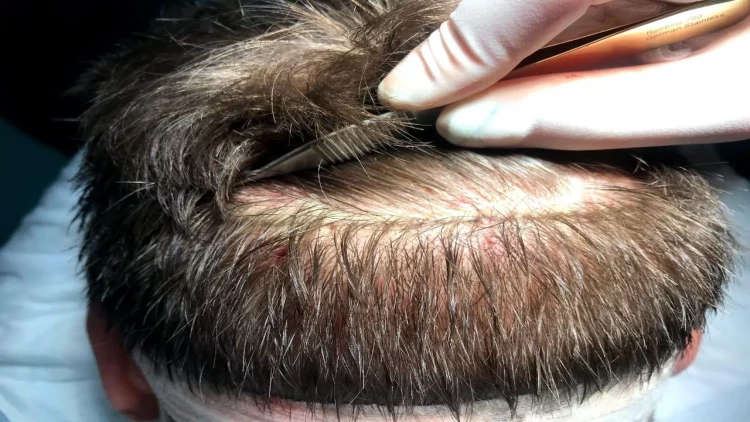 47 yaşlı kişi saç əkimi zamanı öldü