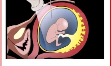 Amniosintez nədir? Nə üçün edilir?