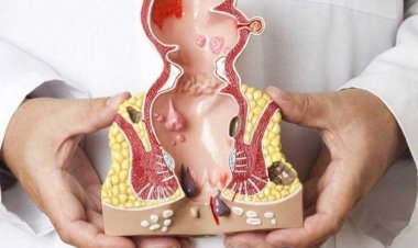 Babasil Müalicəsi, Babasilin Tebii Yolla Mualicesi (Evdə)