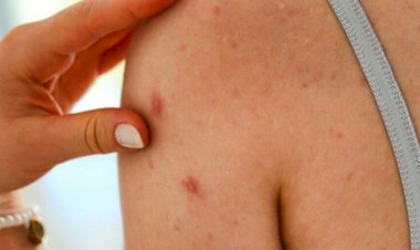 Bədənimizdəki qırmızı nöqtələr nəyin əlamətidir? – SƏBƏB