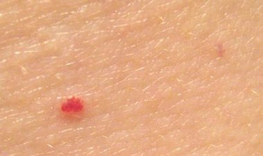 Bədəndə yaranan qırmızı nöqtələr ciddi xəstəlik əlamətidirmi?