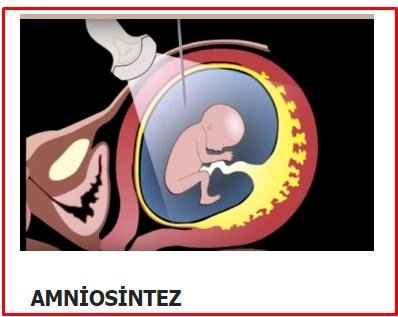 Amniosintez nədir? Nə üçün edilir?