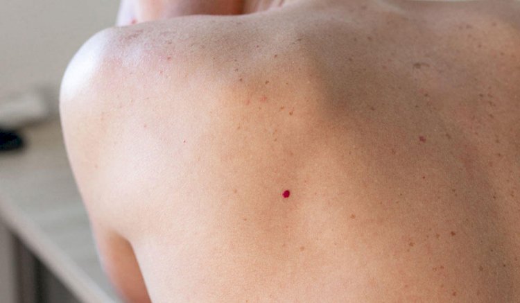 Dermatoloq dəridə qırmızı nöqtələrin yaranma səbəblərini açıqladı